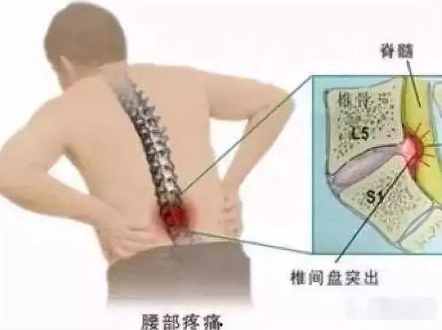 养生堂腰间盘突出视频,腰间盘突出防治之道