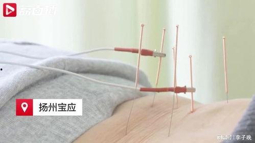 针灸的视频,视频详解与实操指南