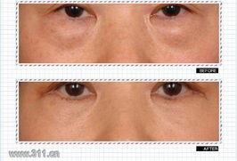 去除眼袋手术视频,专业视频带你直观了解