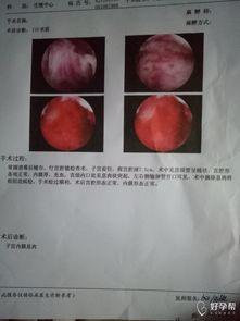 宫腔镜检查视频,直观呈现女性生殖健康检查过程