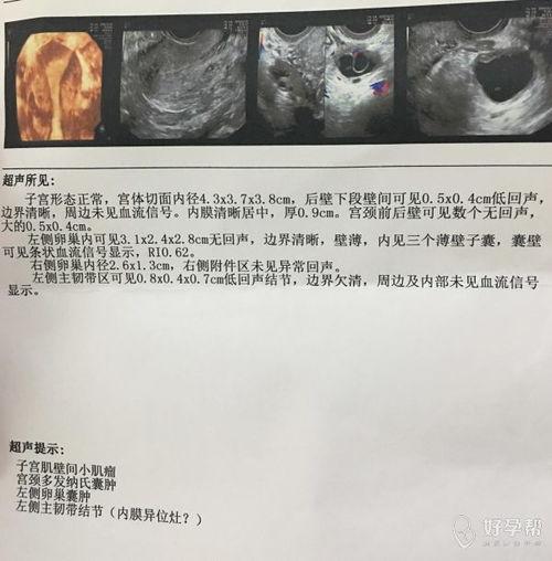 宫腔镜检查视频,直观呈现女性生殖健康检查过程