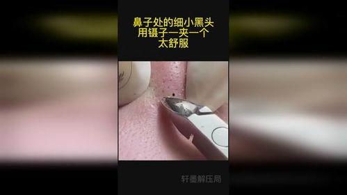 夹黑头视频,夹黑头视频教程解析