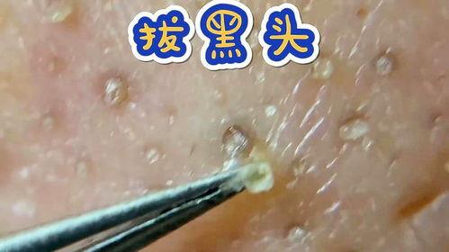 夹黑头视频,夹黑头视频教程解析